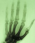 X-ray of Joseph Lister's hand